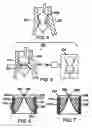 Fig. 05 - Two-step heart valve implantation