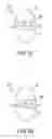 Fig. 07 - Implant device and method for interspinous distraction