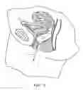 Fig. 03 - Vaginal pessary