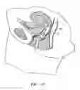 Fig. 05 - Vaginal pessary