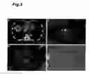 Fig. 06 - Method for detecting cancer using ICG fluorescence method