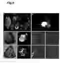 Fig. 07 - Method for detecting cancer using ICG fluorescence method