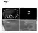 Fig. 08 - Method for detecting cancer using ICG fluorescence method