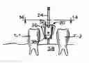 Fig. 01 - Dental implant drill apparatus and method