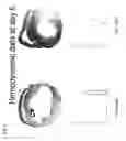 Fig. 06 - Remedies for ischemia