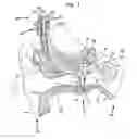 Fig. 02 - IMPLANTED-TRANSDUCER BONE CONDUCTION DEVICE