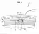 Fig. 06 - IMPLANTED-TRANSDUCER BONE CONDUCTION DEVICE