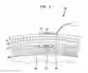 Fig. 07 - IMPLANTED-TRANSDUCER BONE CONDUCTION DEVICE