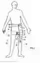 Fig. 03 - Method and device to provide penis enlargement