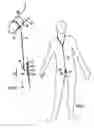Fig. 04 - Method and device to provide penis enlargement