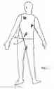 Fig. 07 - Method and device to provide penis enlargement