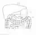 Fig. 07 - Access Systems Including Collapsible Port Body For Intra-Abdominal Surgery