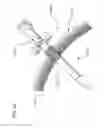 Fig. 64 - Methods and devices to decrease tissue trauma during surgery