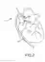 Fig. 03 - Steerable short sheath access device