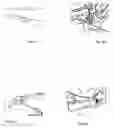 Fig. 03 - Implant for long bones and treatment method