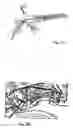 Fig. 08 - Implant for long bones and treatment method