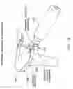 Fig. 22 - Method and apparatus for performing an open wedge, high tibial osteotomy