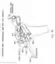 Fig. 32 - Method and apparatus for performing an open wedge, high tibial osteotomy
