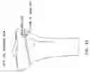 Fig. 35 - Method and apparatus for performing an open wedge, high tibial osteotomy