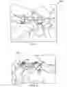 Fig. 05 - METHOD AND APPARATUS FOR REPLACING THE FUNCTION OF FACET JOINTS
