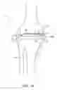 Fig. 02 - Dynamic knee balancer with pressure sensing