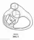 Fig. 03 - Systems and methods to control the dimension of a heart valve