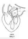 Fig. 04 - Systems and methods to control the dimension of a heart valve