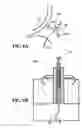 Fig. 07 - Systems and methods to control the dimension of a heart valve