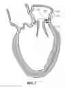 Fig. 08 - Systems and methods to control the dimension of a heart valve