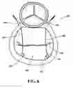 Fig. 09 - Systems and methods to control the dimension of a heart valve