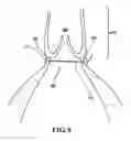 Fig. 10 - Systems and methods to control the dimension of a heart valve