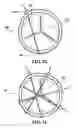 Fig. 11 - Systems and methods to control the dimension of a heart valve