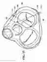 Fig. 13 - Systems and methods to control the dimension of a heart valve