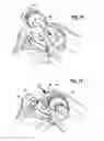 Fig. 08 - Total knee joint mold and methods