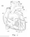 Fig. 02 - VENTRICULAR INFARCT ASSIST DEVICE AND METHODS FOR USING IT