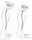 Fig. 08 - Vein stripping device