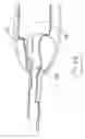 Fig. 33 - Vein stripping device