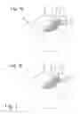 Fig. 02 - TIBIA PLATFORM IMPLANT