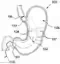 Fig. 01 - Gastrointestinal Prostheses