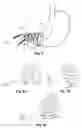 Fig. 02 - Gastrointestinal Prostheses