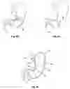 Fig. 06 - Gastrointestinal Prostheses