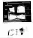 Fig. 42 - Methods for generating new hair follicles, treating baldness, and hair removal