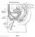 Fig. 02 - ACCESSING A BODY CAVITY THROUGH THE URINARY TRACT