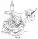 Fig. 02 - Chorionic villus sampling catheter