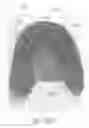 Fig. 97 - Method to capture and support a 3-D contour