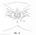 Fig. 29 - IMPLANTS FOR THE TREATMENT OF PELVIC FLOOR DISORDERS
