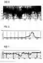 Fig. 04 - Pulse oximetry and pulse oximeter