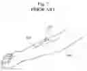 Fig. 08 - Delivery device, system, and method for delivering substances into blood vessels