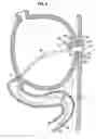 Fig. 05 - GASTROJEJUNAL FEEDING ASSEMBLY