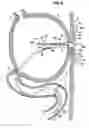 Fig. 06 - GASTROJEJUNAL FEEDING ASSEMBLY